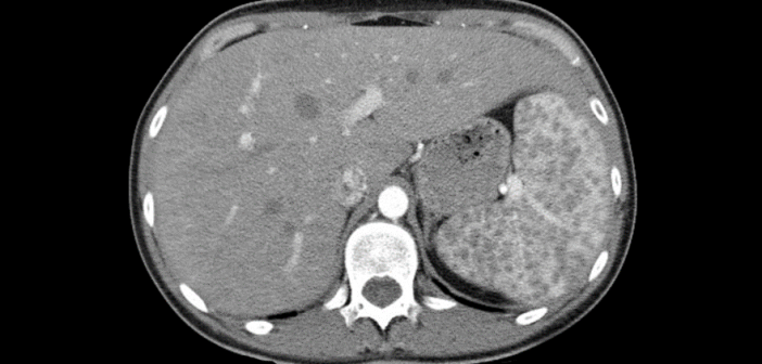 CT scan of liver with extra padding