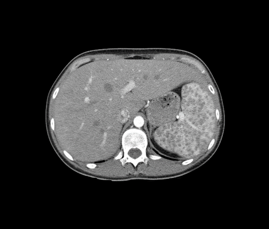 CT scan of liver with extra padding