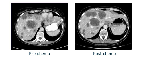 Figure 1: Computer vision in cancer lesion analysis - 3D CT scan before and after chemotherapy