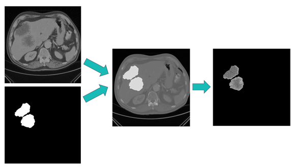 Figure 2: Computer vision in cancer lesion analysis - image-specific masking operation 